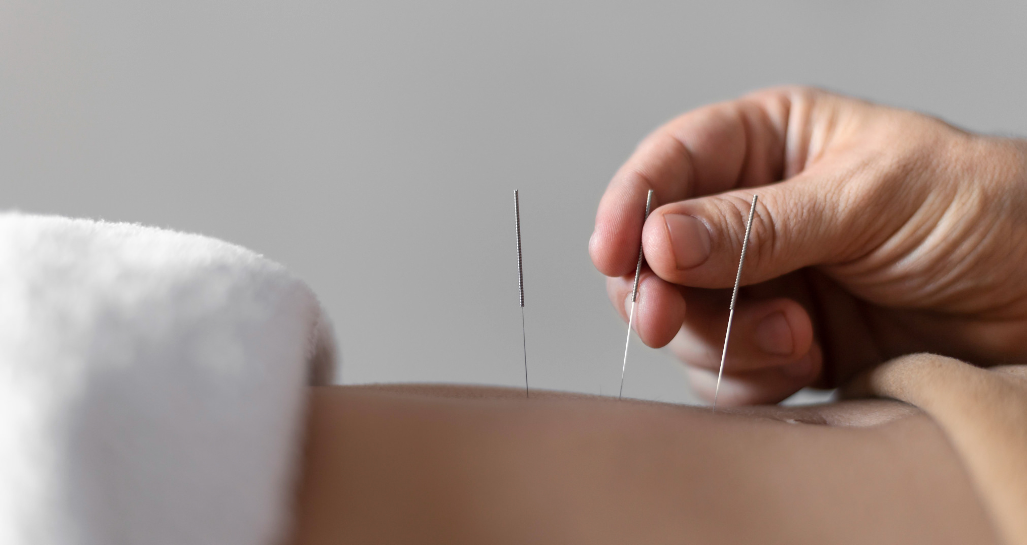 Acupuncture being performed by hand on a person's back